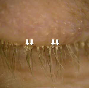 βλεφαριτιδα demodex-οφθαλμιατρος χαριλαου πυλαια τουμπα καλαμαρια θεσσαλονικη