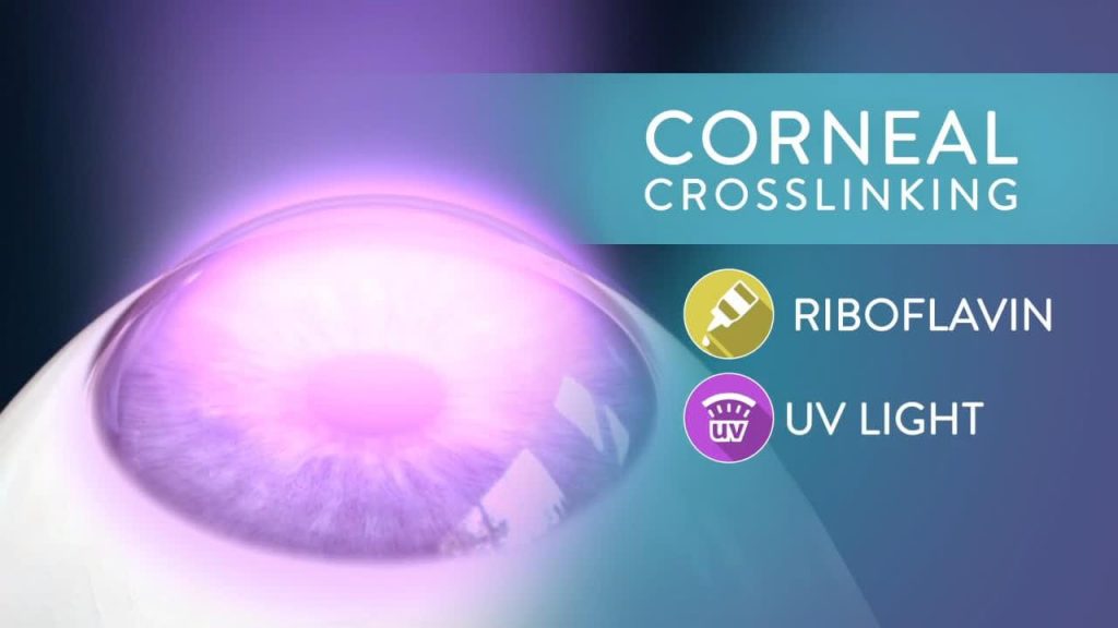 corneal crosslinking-διασύνδεση κολλαγόνου κερατοειδους-οφθαλμιατρος θεσσαλονικη χαριλαου πυλαια καλαμαρια τουμπα