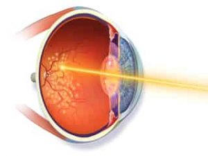 οφθαλμιατρος θεσσαλονικη-argon laser φωτοπηξια