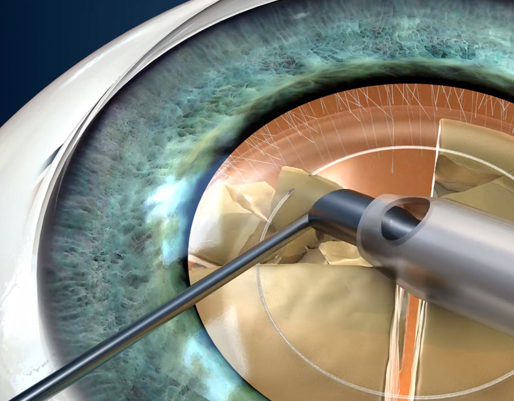 καταρράκτης ματιών- οφθαλμίατρος θεσσαλονίκη-επεμβαση-εγχειρηση καταρρακτη θεσσαλονικη